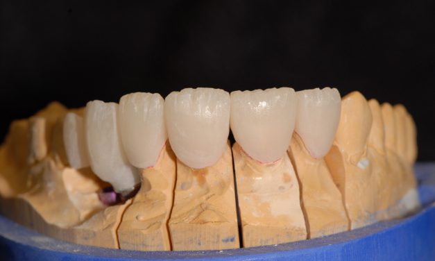 Veneers & Implants Using the Latest Material Choice: Celtra Press