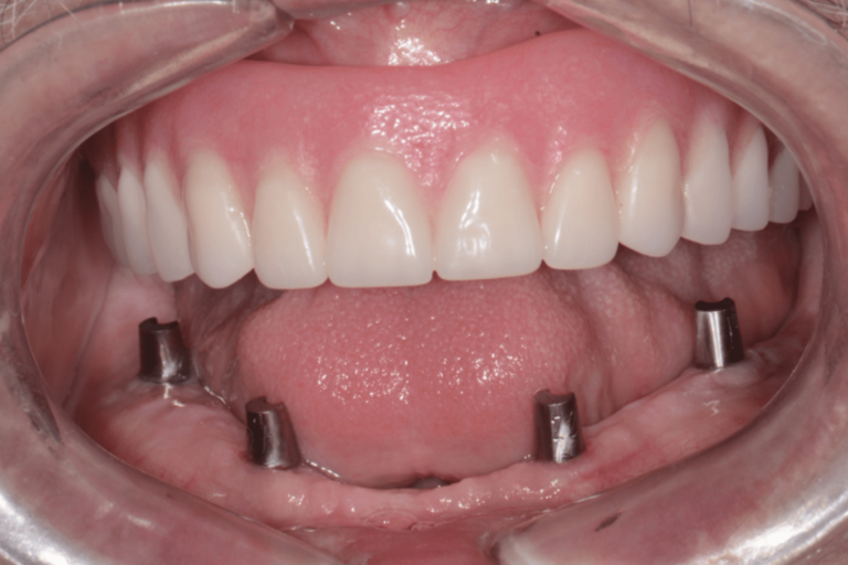 Case Study: Conus® Abutments, a Fixed, Hygienic, Restorative Solution ...