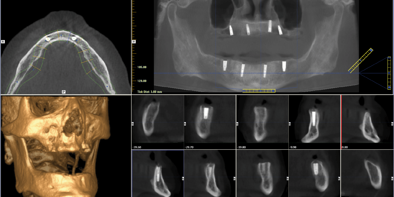 Case Study: Conus® Abutments, a Fixed, Hygienic, Restorative Solution