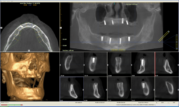 Case Study: Conus® Abutments, a Fixed, Hygienic, Restorative Solution